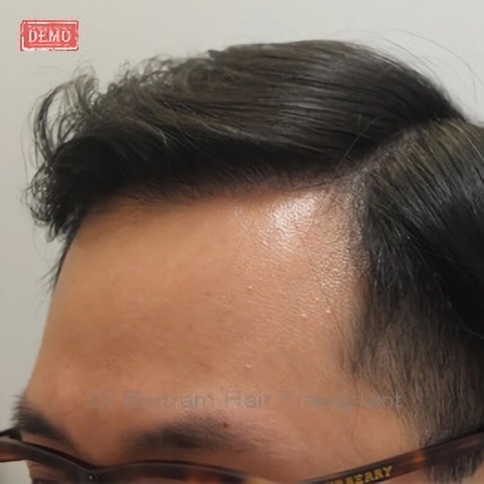 12 months post-procedure: Rear angle