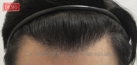 12 months post-procedure: Top view