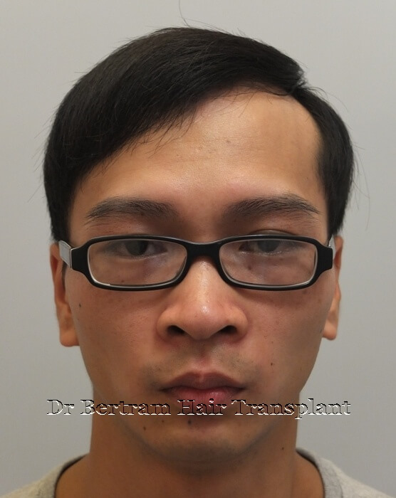 12 months post-procedure: Frontal view