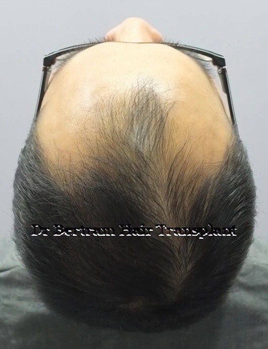 Before: Additional side view