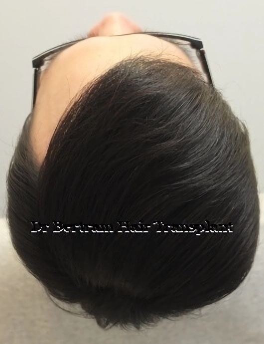 12 months post-procedure: Additional side view
