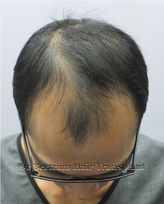 Before: Left side view