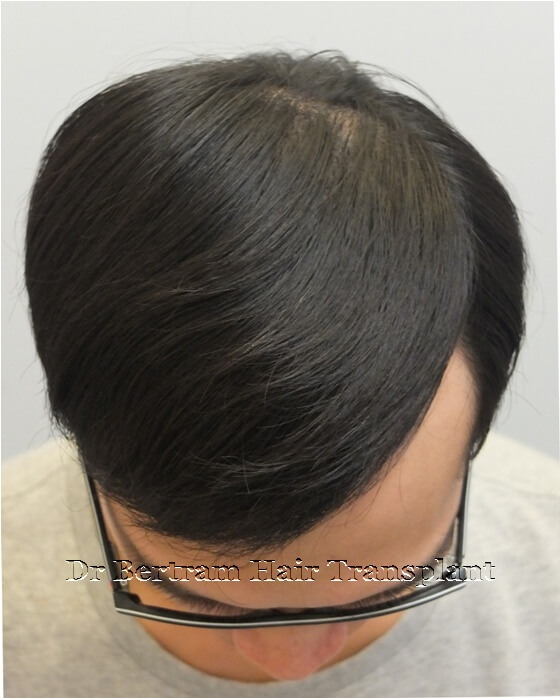 12 months post-procedure: Left side view