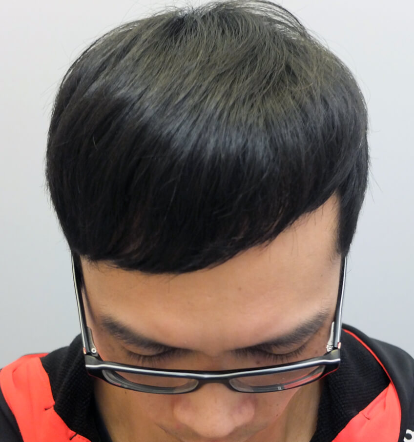 12 months post-procedure: Right side view