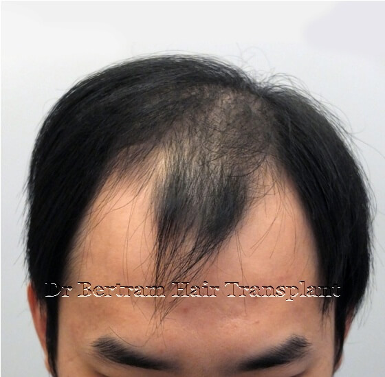 Before: Frontal view, Class IVa pattern