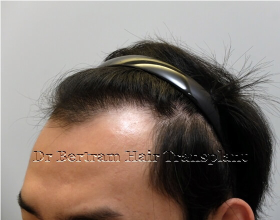 12 months post-procedure: Right side view