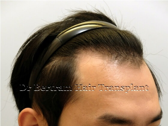 12 months post-procedure: Rear view