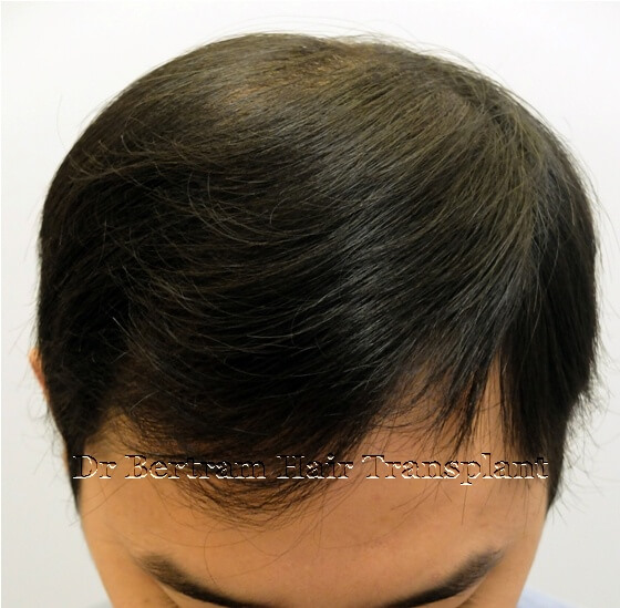 12 months post-procedure: Frontal view