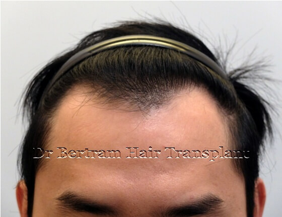 12 months post-procedure: Top view