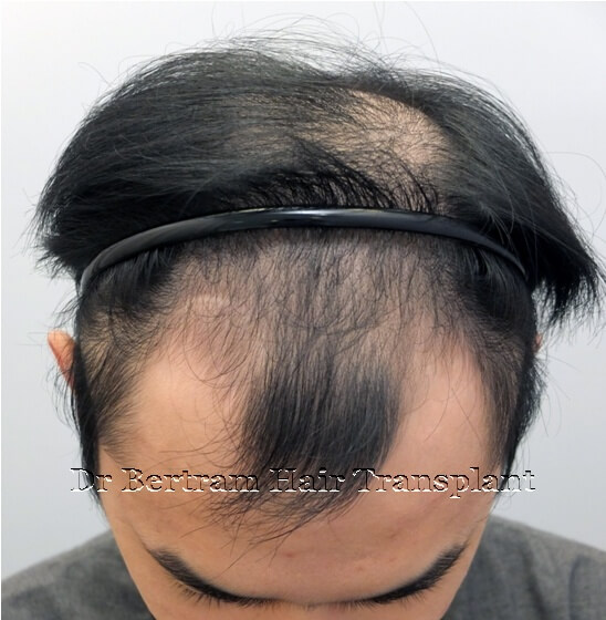 Before: Left side view