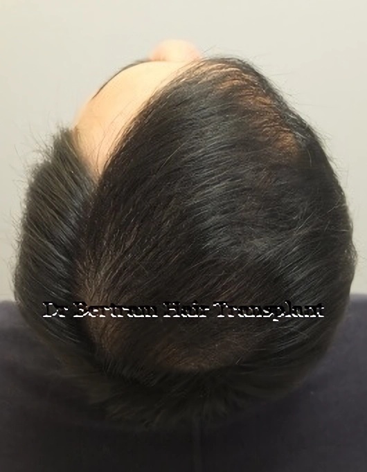 12 months post-procedure: Close-up view