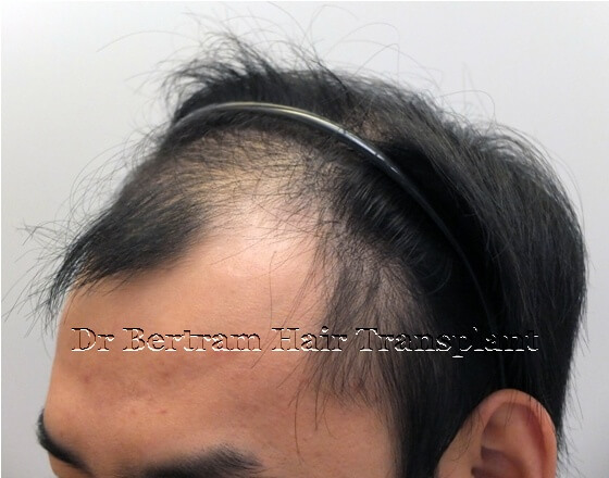Before: Right side view