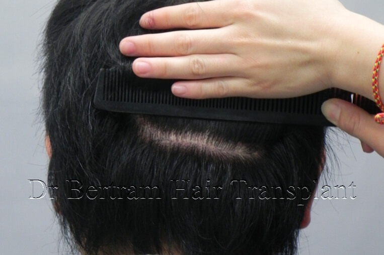 12 months post-procedure: Rear view