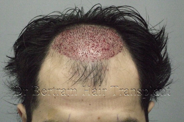 12 months post-procedure: Frontal view