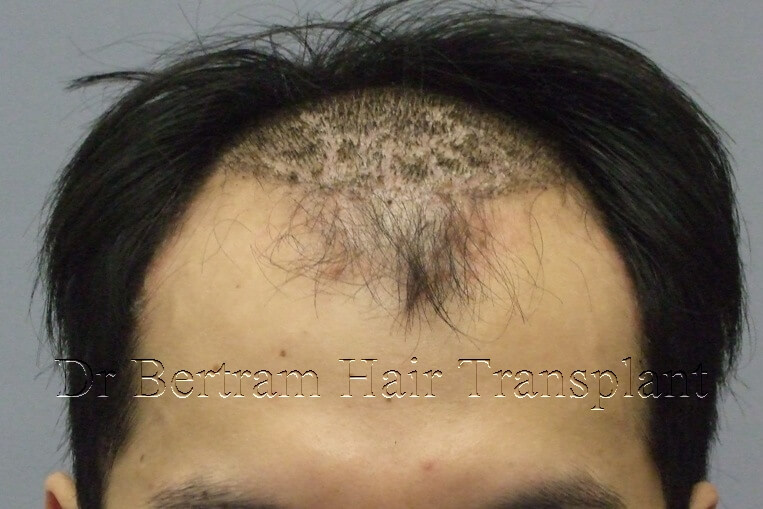 12 months post-procedure: Top view