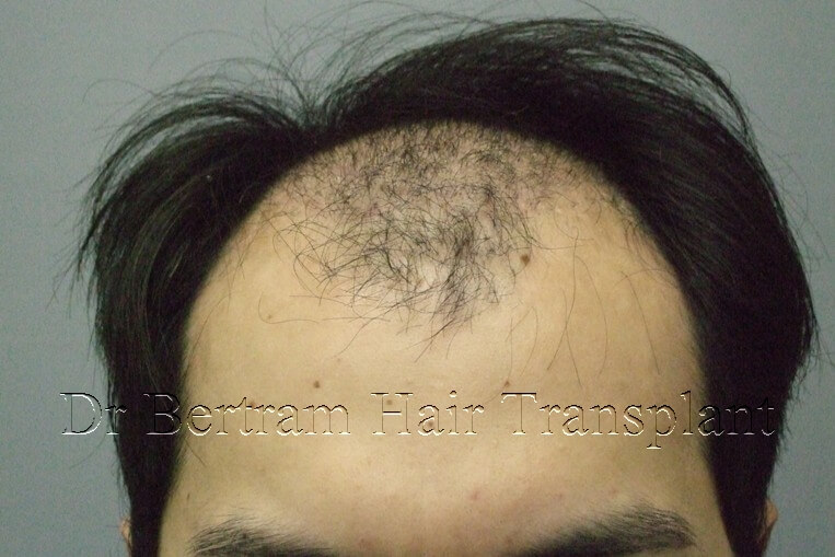 Before: Side view