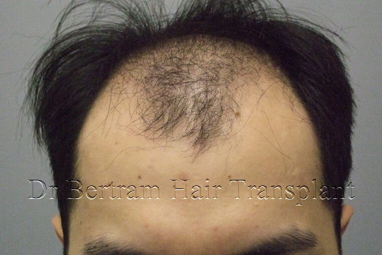 12 months post-procedure: Side view