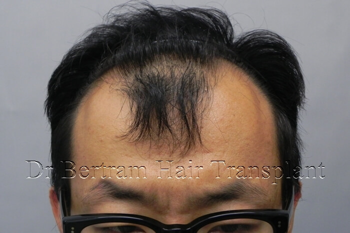 Pre-procedure