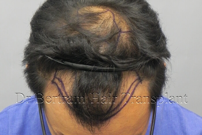 Hairline design