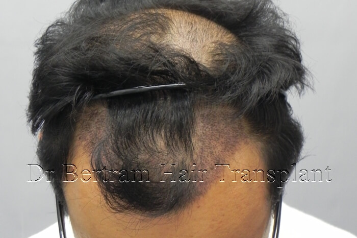 1 week post-procedure