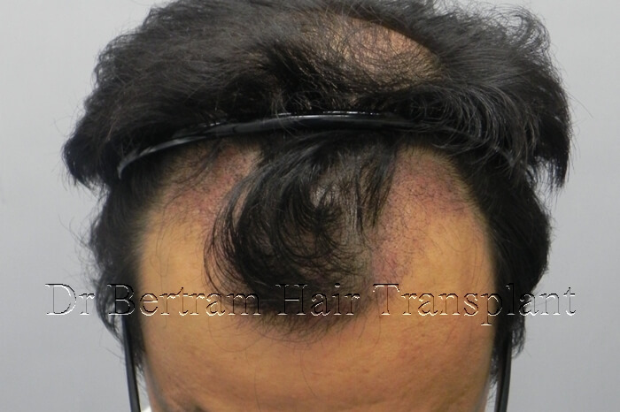 1 month post-procedure