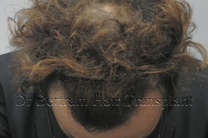 8 months post-procedure