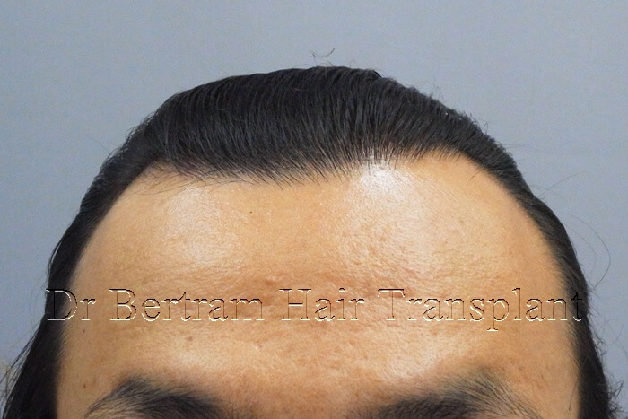 12 months post-procedure
