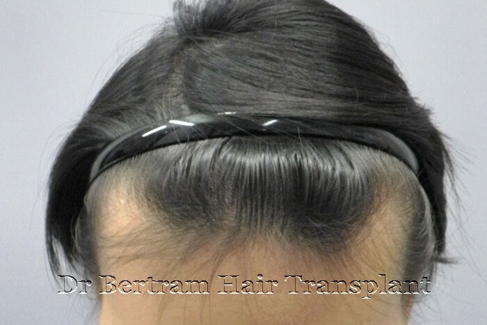 Clinical case: Female age 24