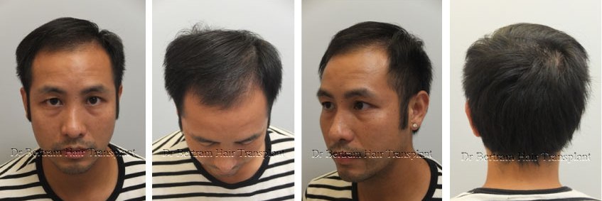 4 months post-procedure