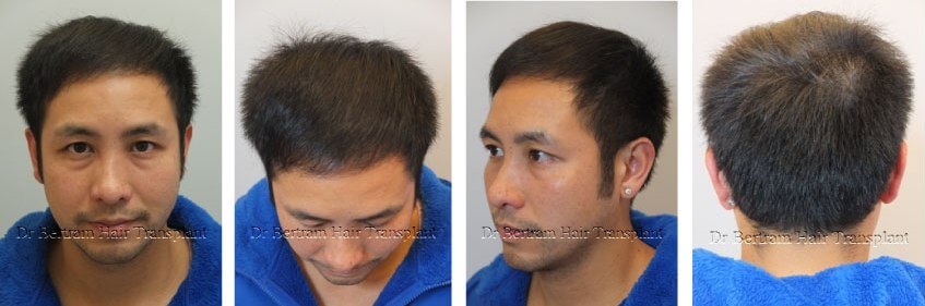8 months post-procedure