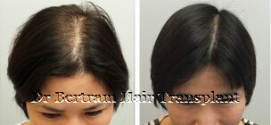 Case 1: Diffuse thinning