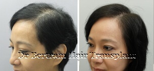 Case 2: Diffuse thinning