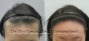 Case 3: High forehead