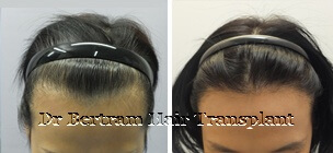 Case 4: High forehead