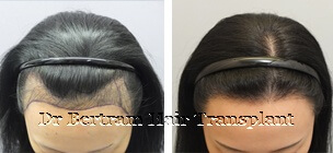 Case 5: High forehead