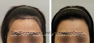 Case 6: High forehead