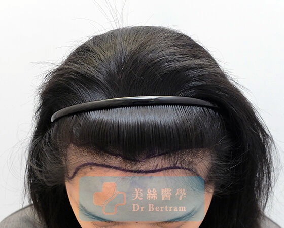 Pre-procedure