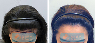 Case 7: High forehead