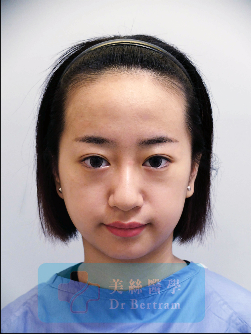 術前