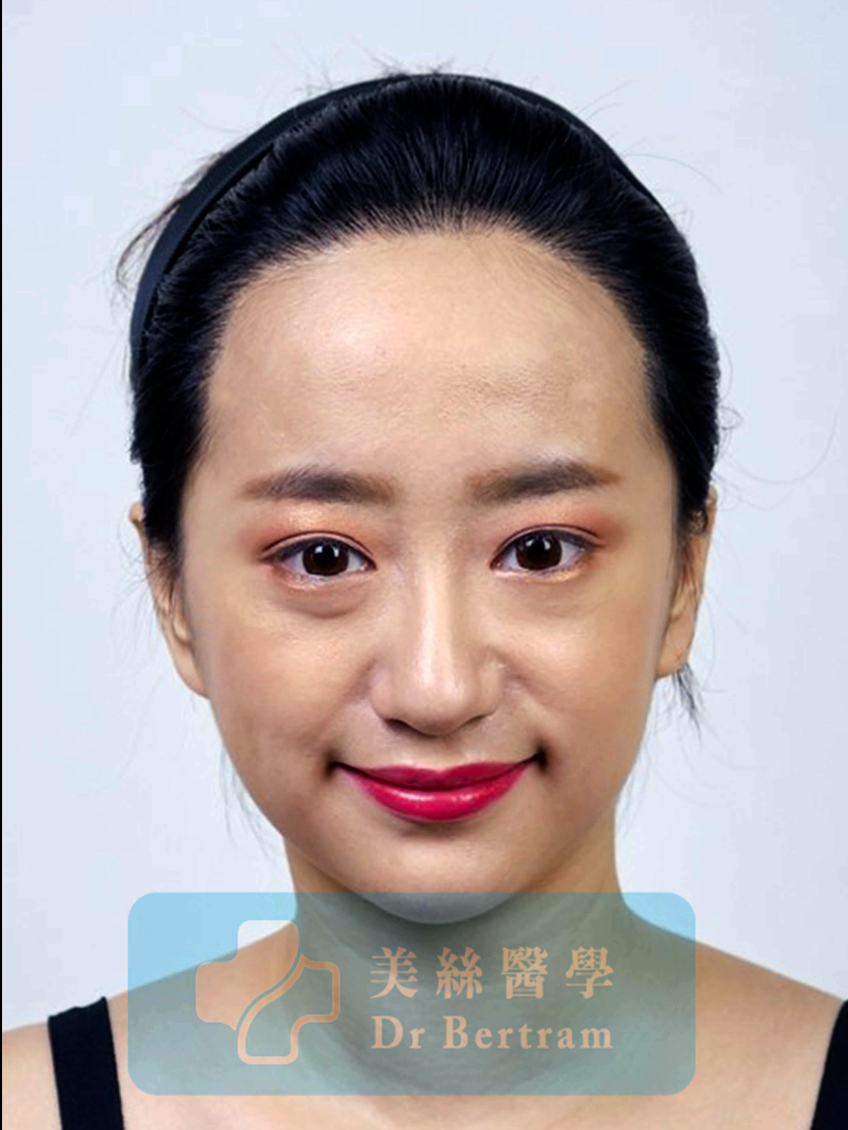 術後12個月