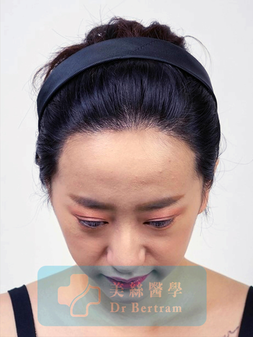 術後12個月