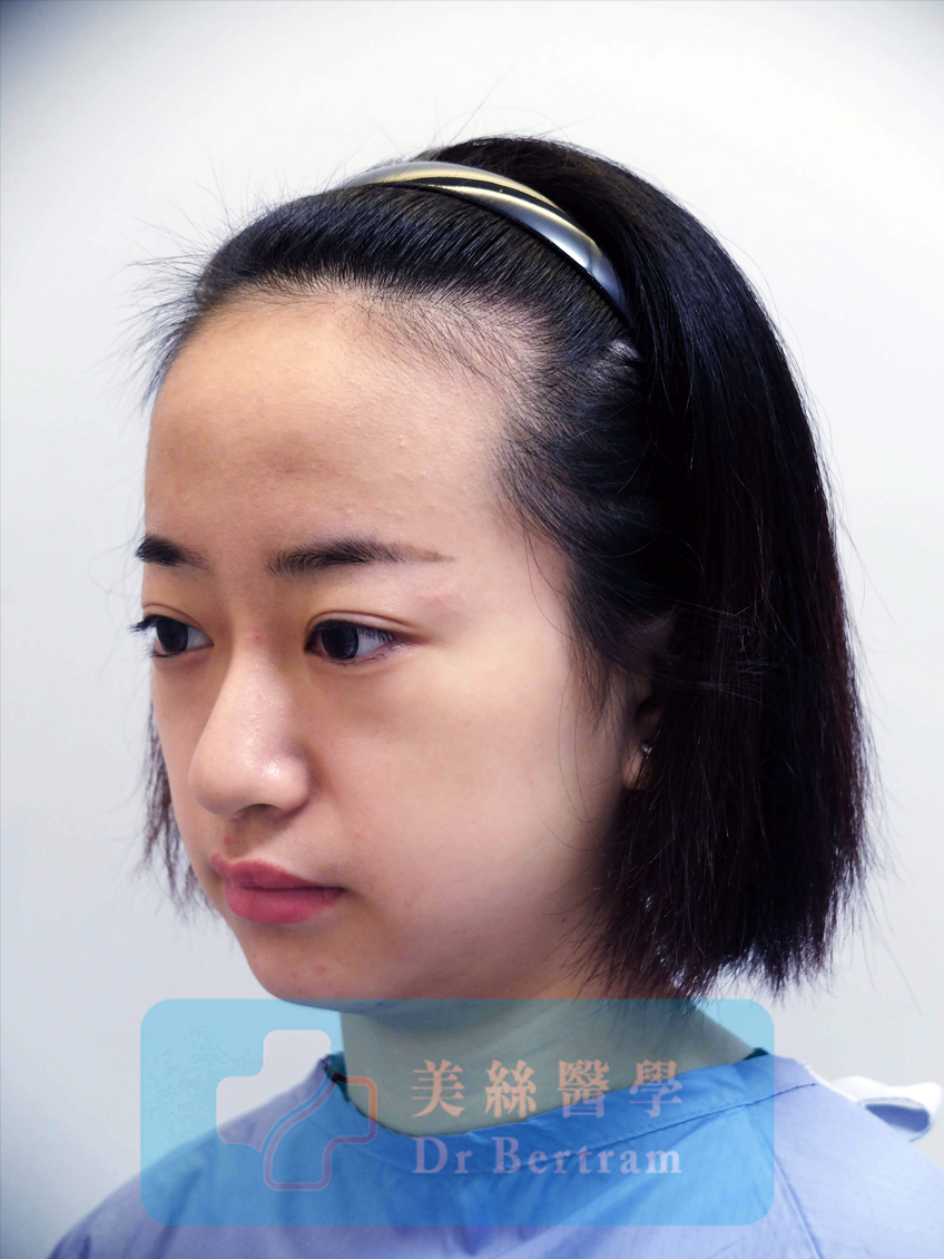 術前