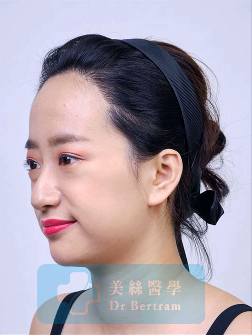 術後12個月
