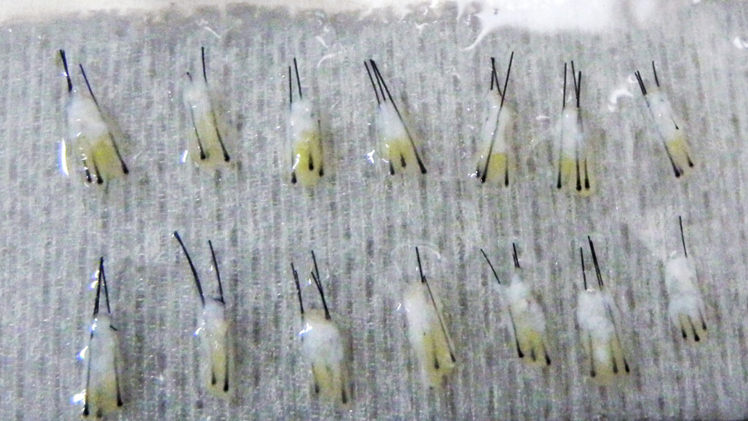 14 grafts containing 39 hairs