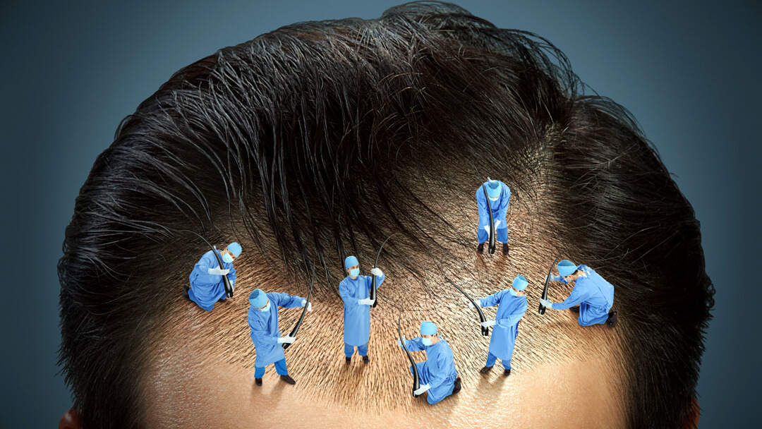 Anagen Effluvium and hair transplant