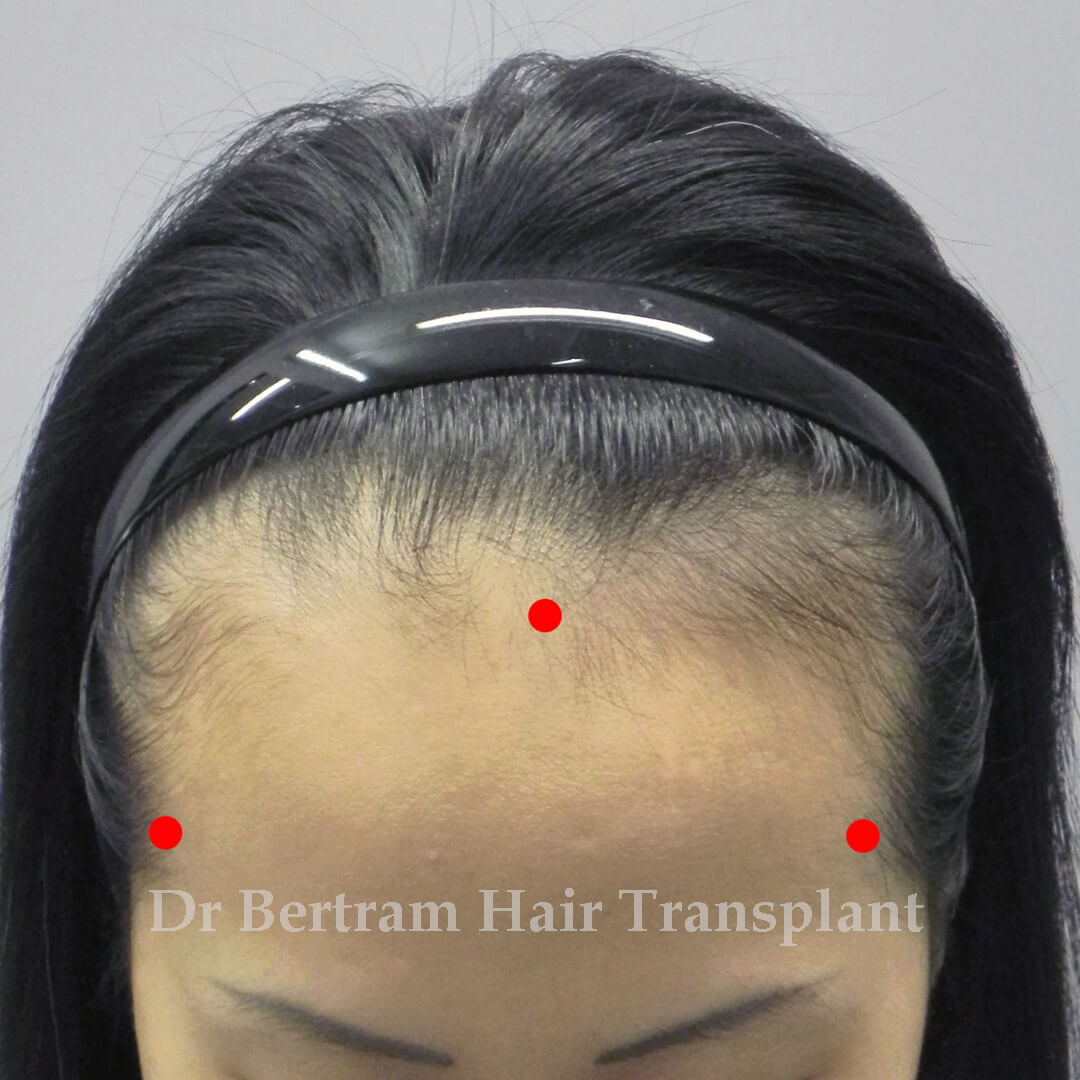 Hairline marking