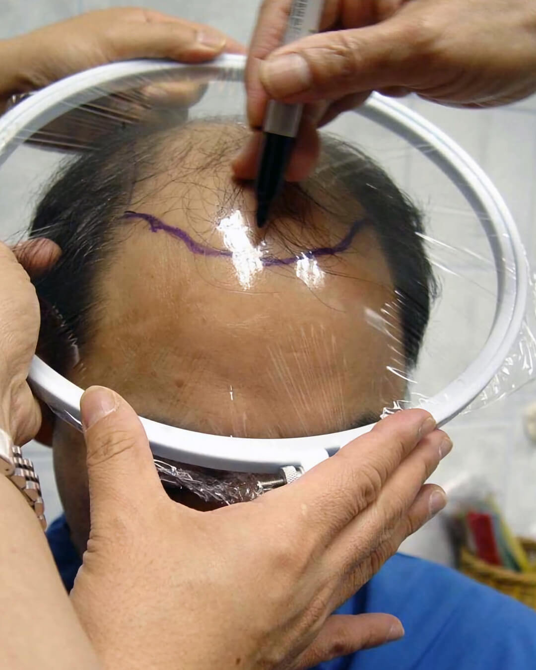 Hairline assessment for cost estimation