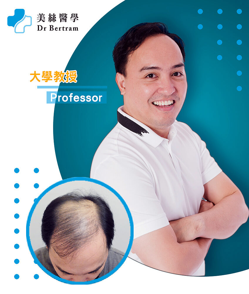 Hair restoration before and after