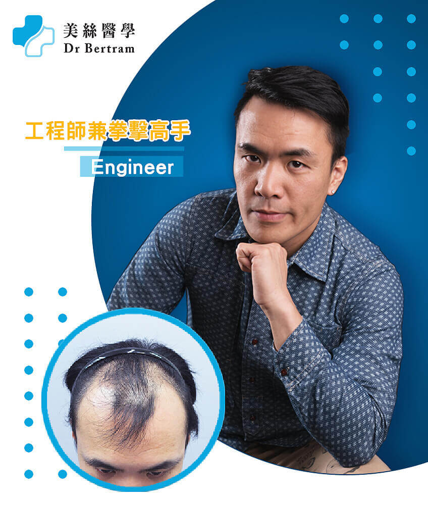 Hair restoration clinical result