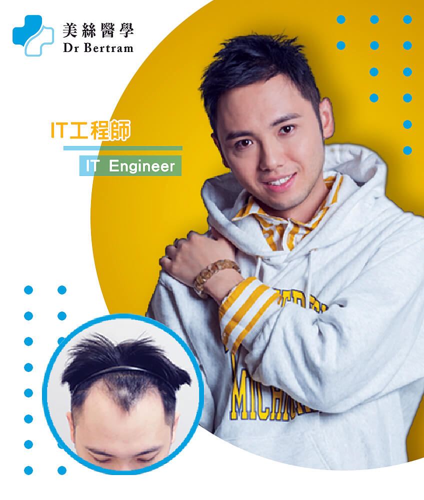 Hair restoration clinical result